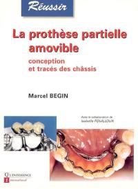 La prothèse partielle amovible : conception et tracés des châssis