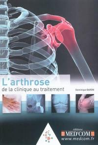 L'arthrose : de la clinique au traitement