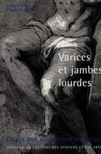 Varices et jambes lourdes