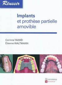 Implants et prothèse partielle amovible