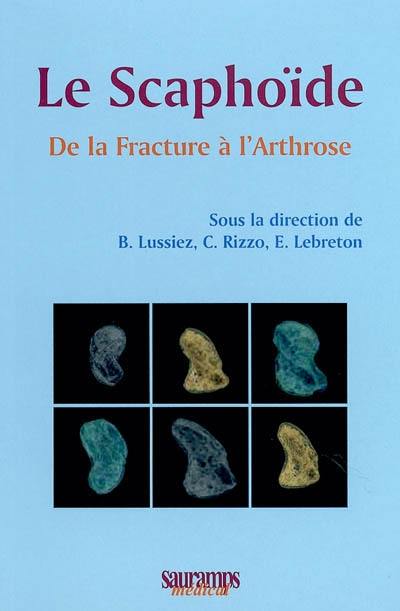 Le scaphoïde : de la fracture à l'arthrose