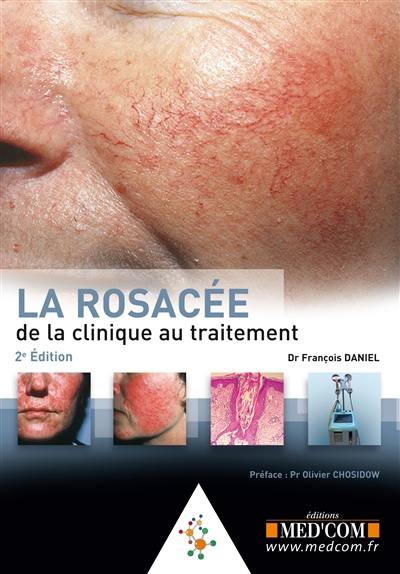 La rosacée : de la clinique au traitement